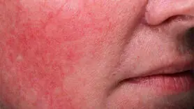 تاثیرات مخرب هوای شرجی بر زیبایی