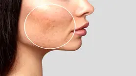 6 راهکار موثر برای کوچک کردن منافذ پوست