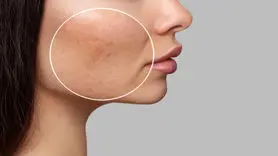 6 راهکار موثر برای کوچک کردن منافذ پوست