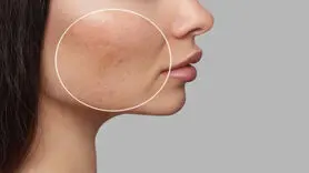 6 راهکار موثر برای کوچک کردن منافذ پوست