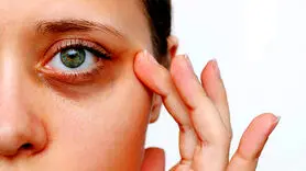 برای درمان سیاهی دور چشم چه بخورید؟
