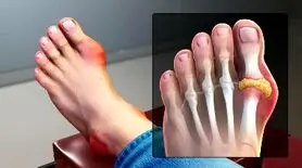 نقش گوجه‌فرنگی در تشدید نقرس: تحقیقات علمی چه می‌گویند؟