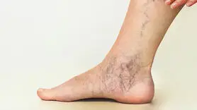 چرا به واریس مبتلا می شوید؟ + بهترین روش‌ درمان واریس 