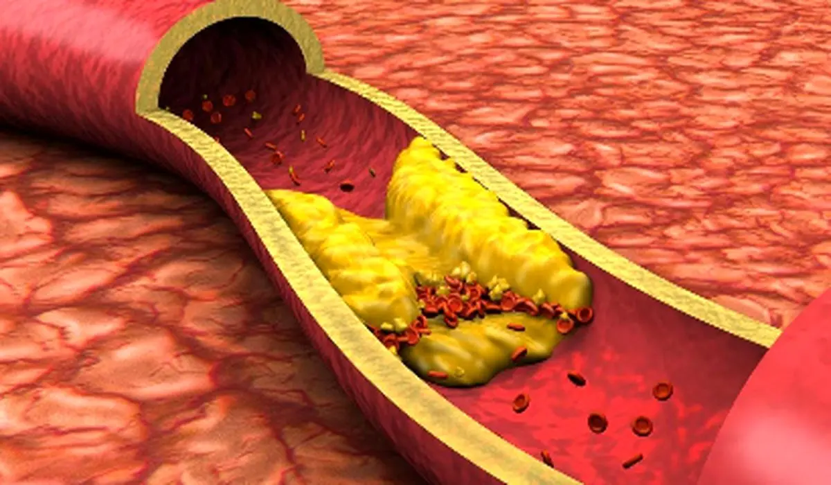 ۷ علامتی که نشان می‌دهد احتمال گرفتگی رگ‌های قلب وجود دارد