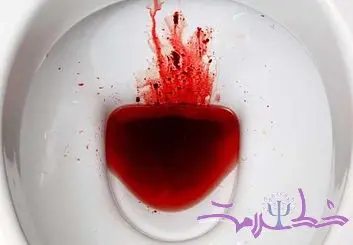 خون در مدفوع: علل، نشانه ها و راهکارهای درمان