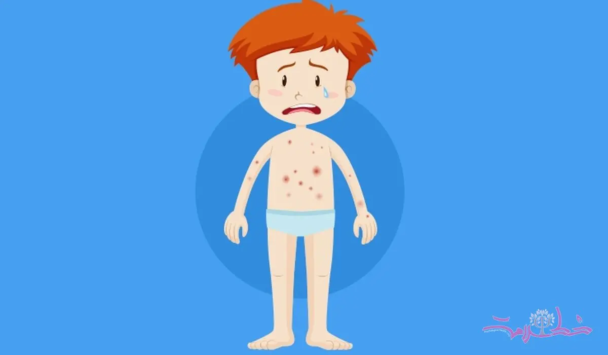 ویروس آبله مرغان در یک قدمی شماست / همه چیز درباره آبله مرغان