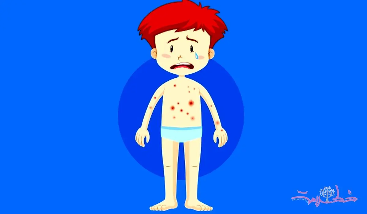 ویروس آبله مرغان در یک قدمی شماست / همه چیز درباره آبله مرغان