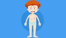 ویروس آبله مرغان در یک قدمی شماست / همه چیز درباره آبله مرغان