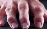 زندگی با آرتریت روماتوئید؛ چند نکته مهم برای کاهش درد و حفظ حرکت 