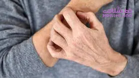 آیا استرس باعث ایجاد کهیر می شود؟