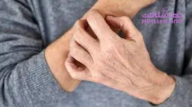 آیا استرس باعث ایجاد کهیر می شود؟