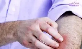 آلرژی چه تاثیری بر خلق و خو دارد؟ / اگر کلافه اید بخوانید