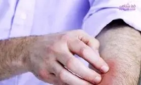 آلرژی چه تاثیری بر خلق و خو دارد؟ / اگر کلافه اید بخوانید