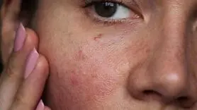 6 روش خانگی از بین بردن رگ های تیره پوست های نازک صورت