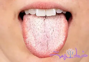 4 حالت زبان از توت فرنگی تا سفید و سیاه و جغرافیایی نشانگر چه وضعیتی از سلامتی است؟