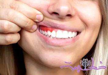 تاثیر چاقی، بر لثه ها چیست؟