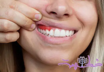 تاثیر چاقی، بر لثه ها چیست؟