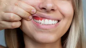 تاثیر چاقی، بر لثه ها چیست؟