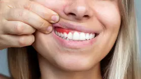 تاثیر چاقی، بر لثه ها چیست؟