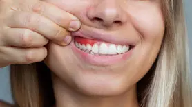 تاثیر چاقی، بر لثه ها چیست؟