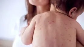 علائم سرخک و تایم انتقال آن 