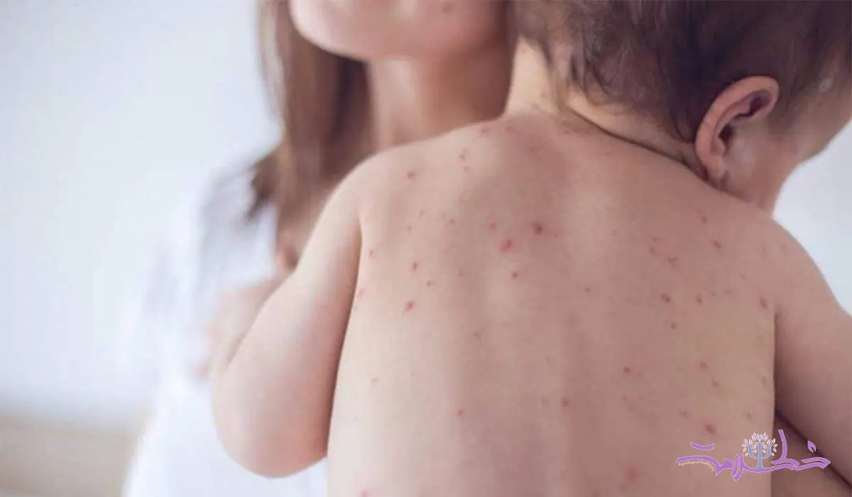 علائم سرخک و تایم انتقال آن 