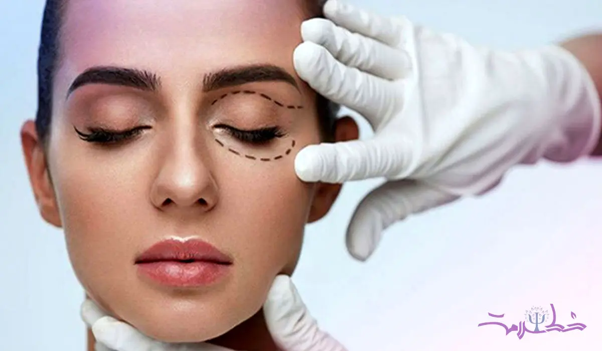 بوتاکس چشم گربه ای چیست؛ چه کسانی باید پرهیز کنند؟ / مراقبتهای بعد از بوتاکس چشم گربه ای و عوارض آن