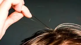 اگر دائم موهایتان را می کَنید، اختلال مو کنی دارید