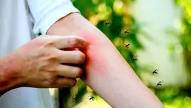 جدید ترین روش های رفع خارش جای نیش پشه