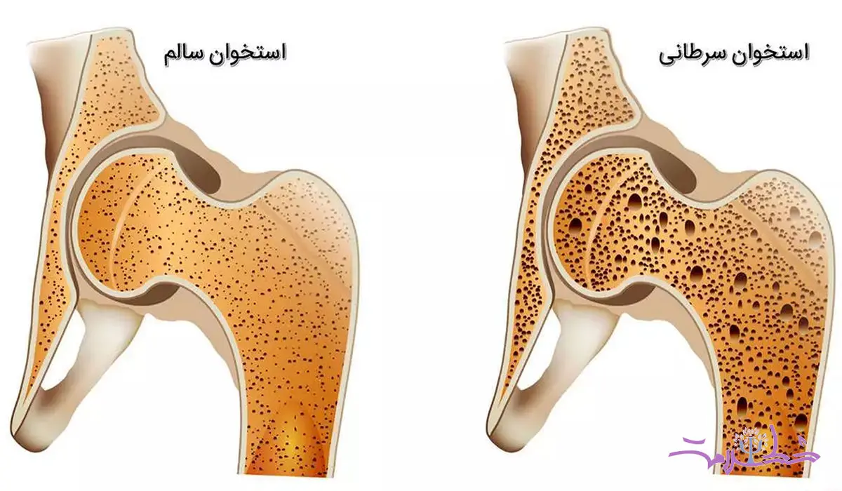 مهم ترین علل و علایم سرطان استخوان