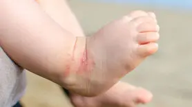 کمبود این ویتامین موجب اگزما و خشکی شدید پوست می‌شود