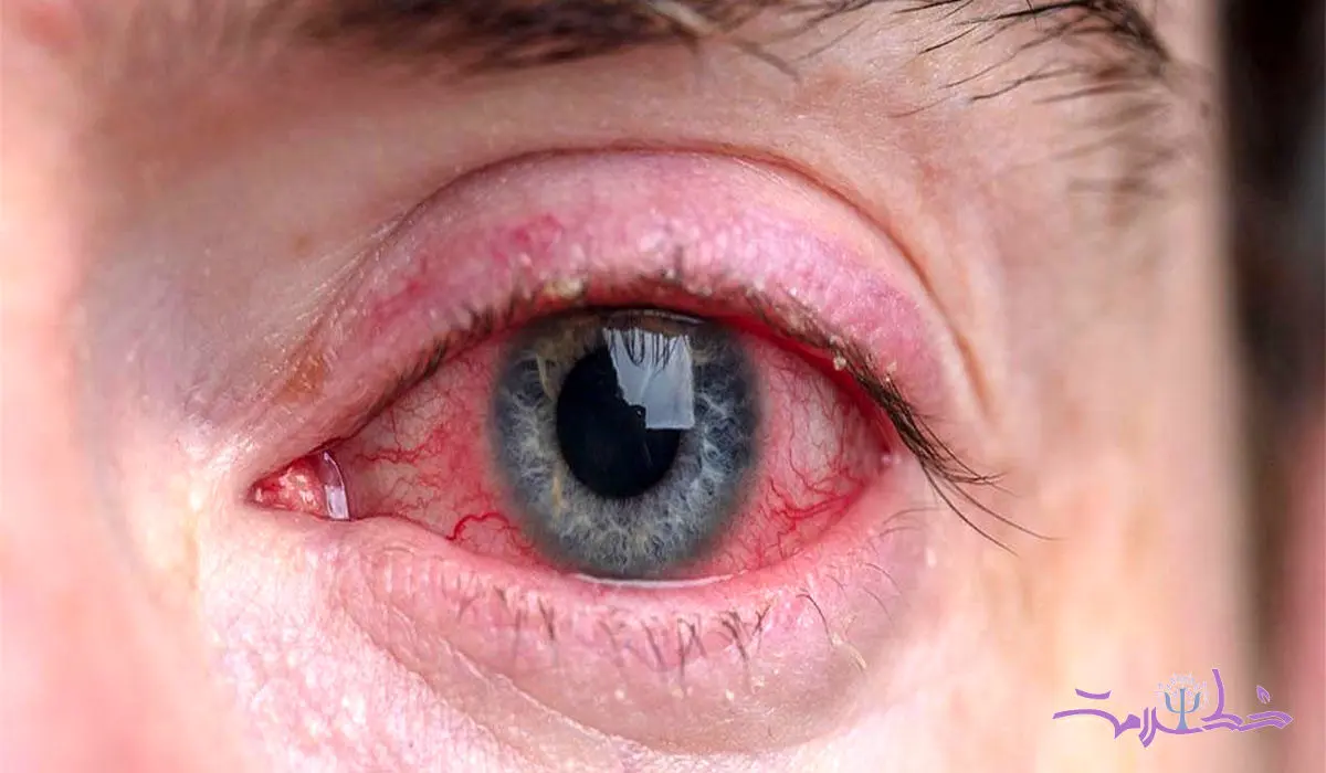عوامل مهم قرمزی چشم و راه های بهبود آن را بدانید