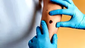 چگونه از شایع‌ترین سرطان جامعه فاصله بگیرید!
