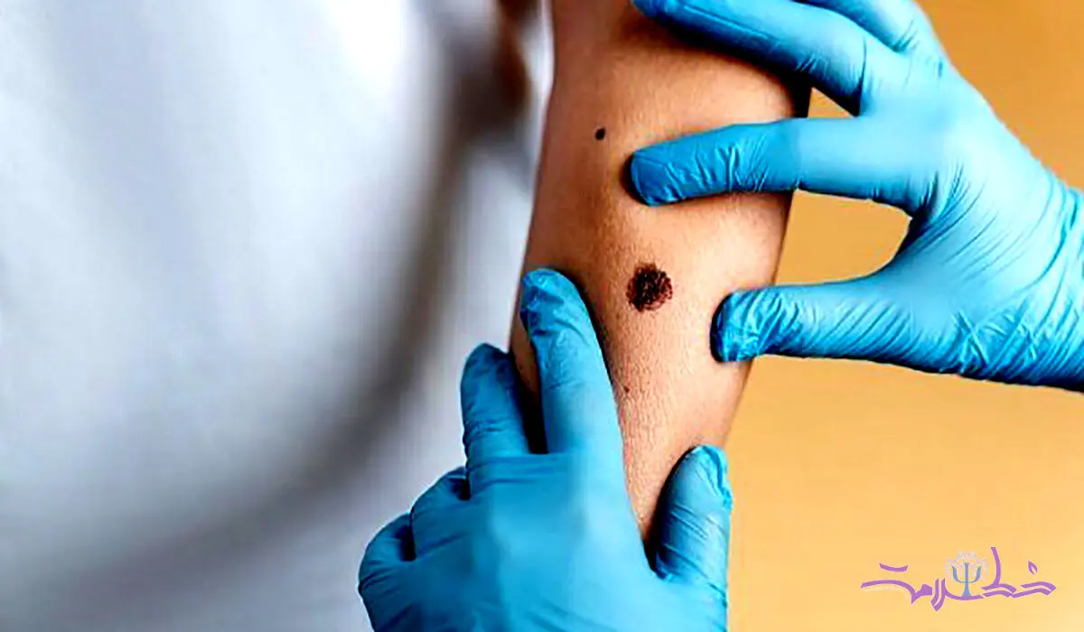 چگونه از شایع‌ترین سرطان جامعه فاصله بگیرید!