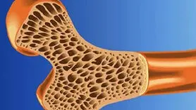 پوکی استخوان در نیمی از جمعیت کشور / وضعیت دستگاه‌های سنجش تراکم استخوان