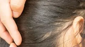 علائم شپش سر و روش‌های درمانی سریع 