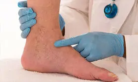 چگونه از بروز وریدهای واریسی پیشگیری کنیم؟ 