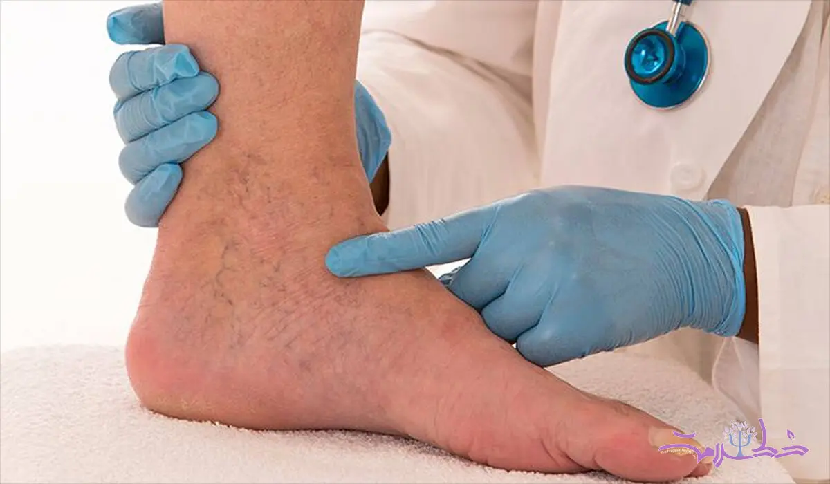 چگونه از بروز وریدهای واریسی پیشگیری کنیم؟ 