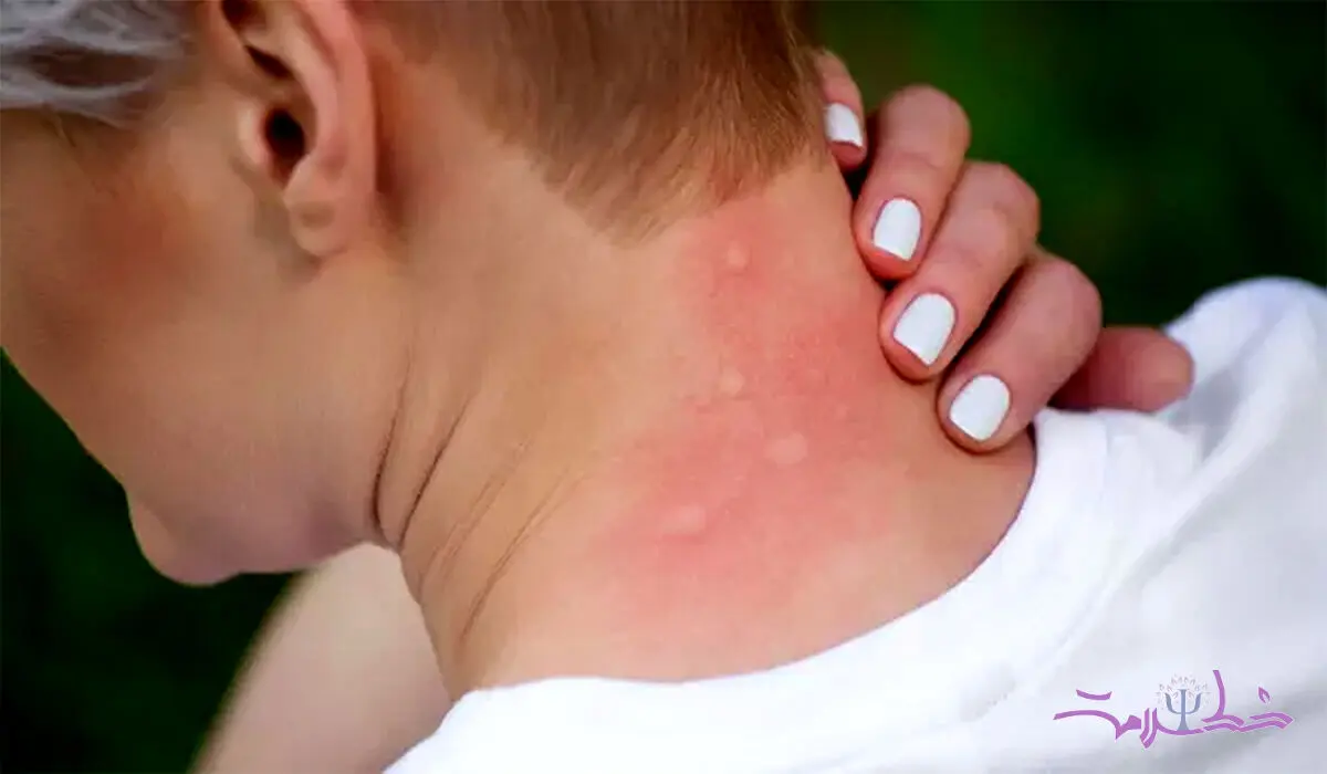 سندرم اسکیتر چیست؟ + واکنش شدید به نیش پشه چرا اتفاق می افتد؟