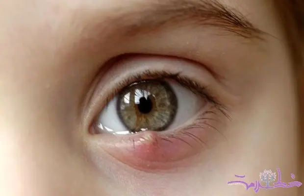 درمان فوری گل مژه با عسل + فیلم