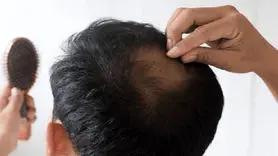 شش روغن طبیعی برای کاهش ریزش مو