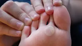 آخرین رویکردهای علمی در درمان میخچه و پینه + مراقبت‌های خانگی ایمن