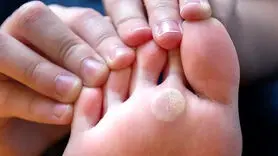 آخرین رویکردهای علمی در درمان میخچه و پینه + مراقبت‌های خانگی ایمن