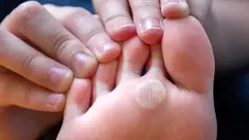 آخرین رویکردهای علمی در درمان میخچه و پینه + مراقبت‌های خانگی ایمن
