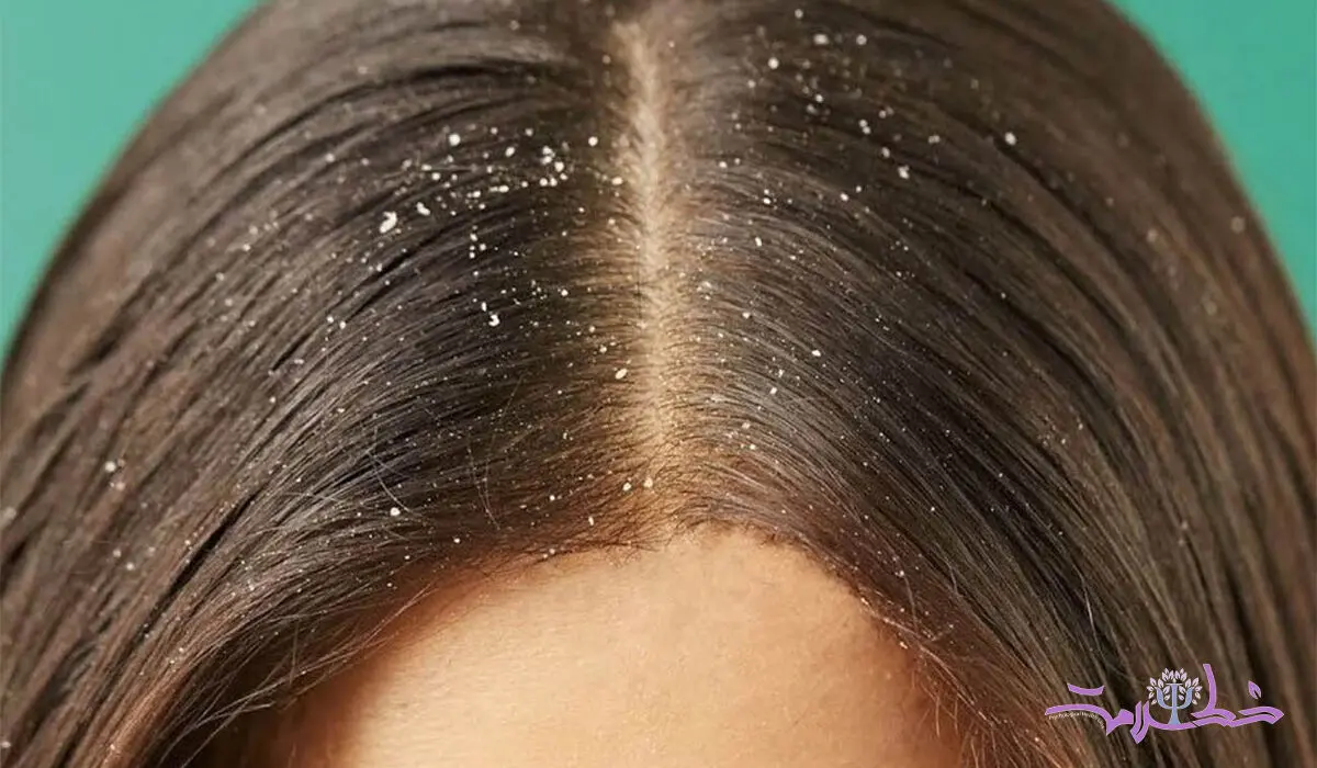  شوره سر دیگر نگران کننده نیست+ متخصصان از آخرین شیوه های خانگی گفتند