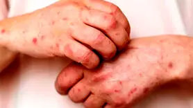 آبله مرغان و آبله میمونی چه تفاوتی دارند؟