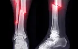 درک شکستگی استخوان -- مبانی / تکمیل
