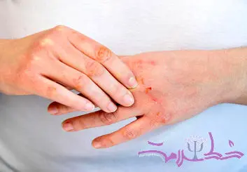 چگونه از پوسته پوسته شدن دست و صورت در سرما جلوگیری کنیم؟ / معرفی 0 راهکار طبیعی و موثر