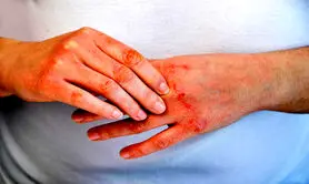 چگونه از پوسته پوسته شدن دست و صورت در سرما جلوگیری کنیم؟ / معرفی 0 راهکار طبیعی و موثر