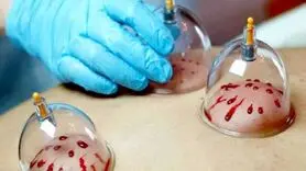 حجامت در بهار فواید و بهترین زمان برای انجام آن